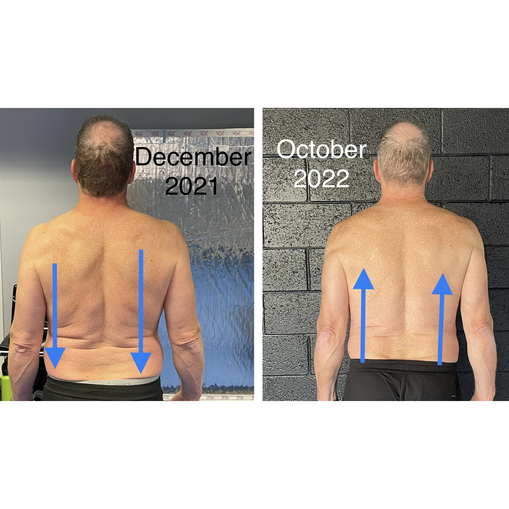 Lower Back Decompression (Pain Relief) Before and After