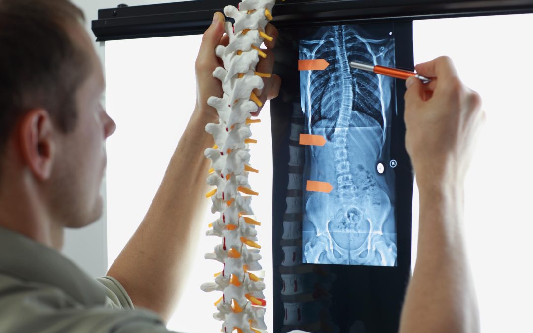 Non-Surgical Scoliosis Treatment: Effective Options for Managing Your Spine Health